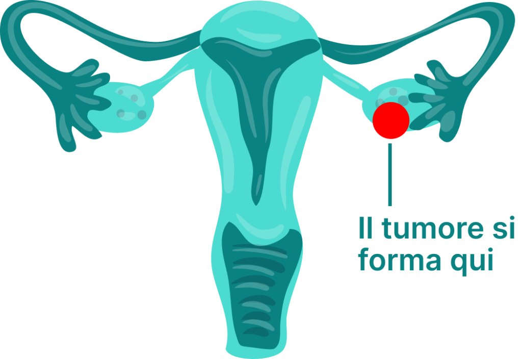 Tumore alle ovaie