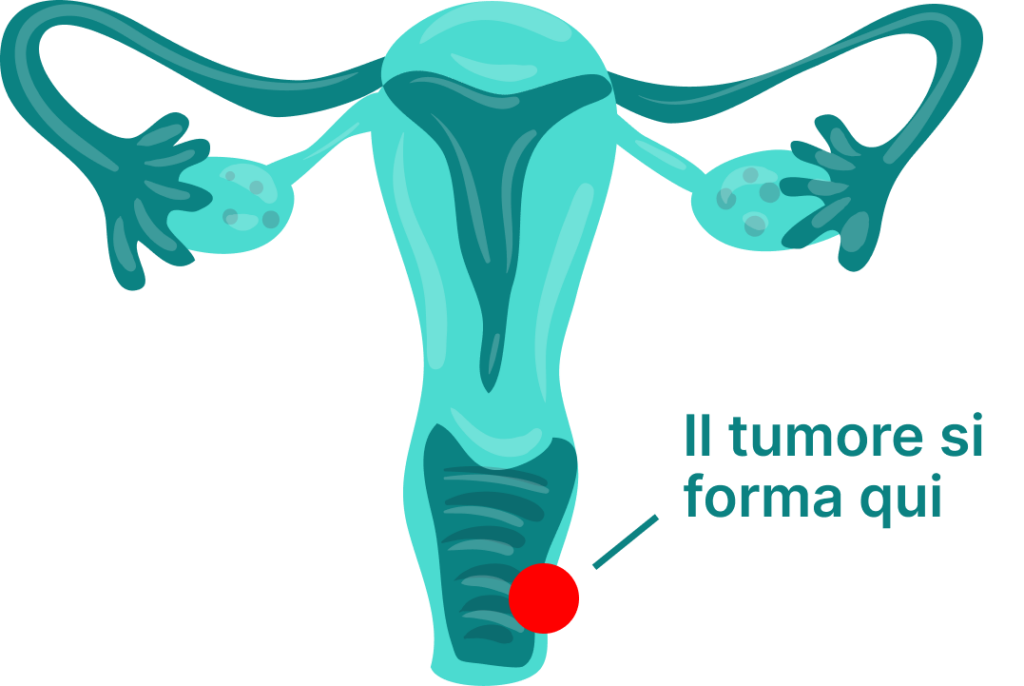 Tumore della vulva