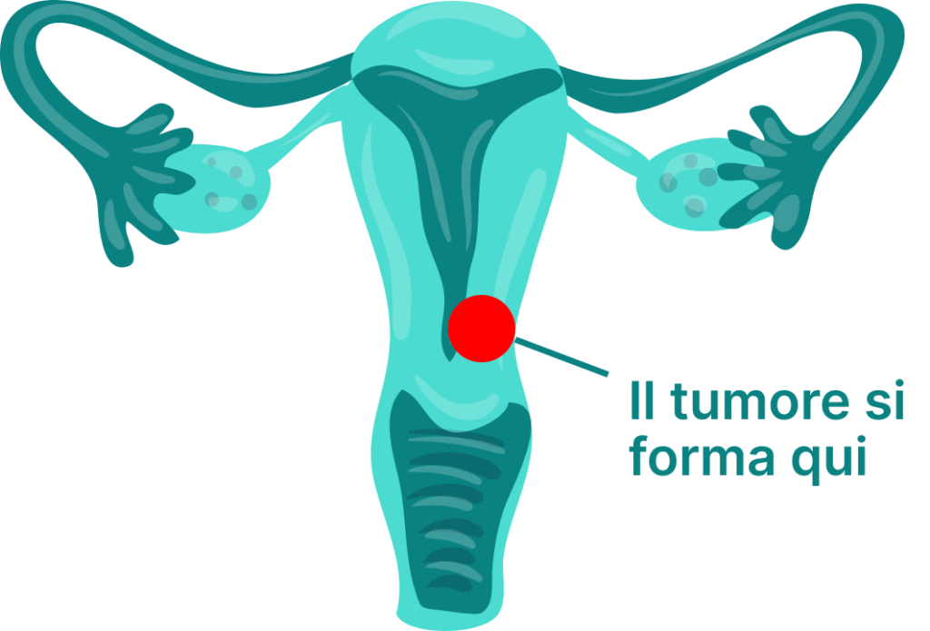 Tumore della cervice uterina