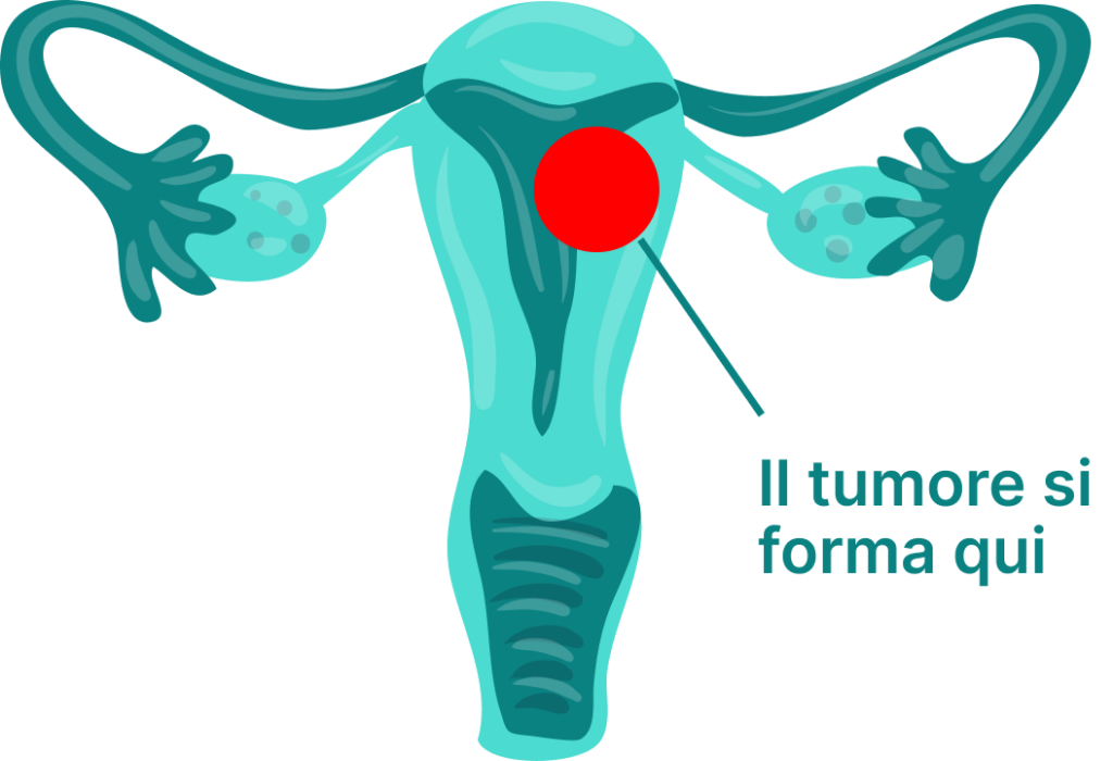 Tumore dell'utero